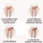 Développement de la carie