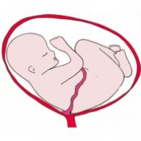 La présentation par l'épaule. Bébé est pratiquement allongé horizontalement dans le ventre de sa mère. Bébé s