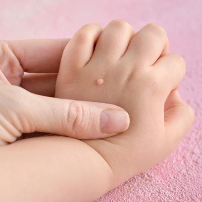 Les verrues sont de petites excrossances ou des petites lésions de la peau causées par un virus. Elles sont contagieuses, particulièrement les v...